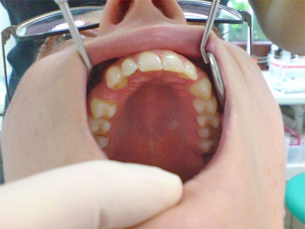 Oberkiefer nach Abschluss der Behandlung