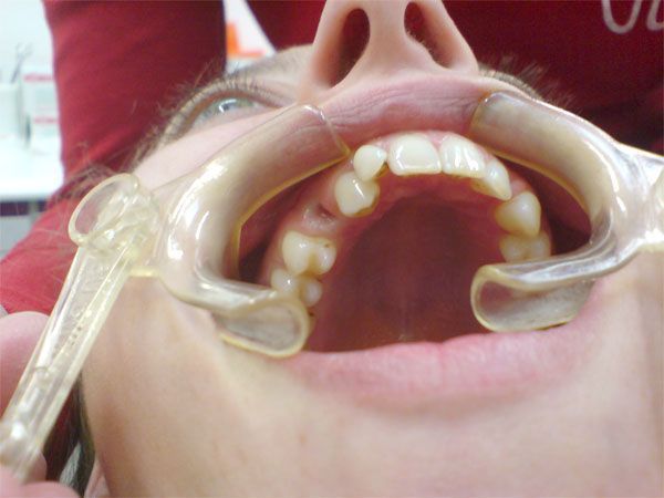 Oberkiefer Ausgangsbefund