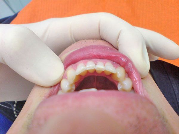 Unterkiefer nach Abschluss der Behandlung