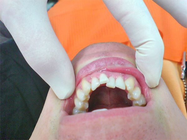 Unterkiefer Ausgangsbefund